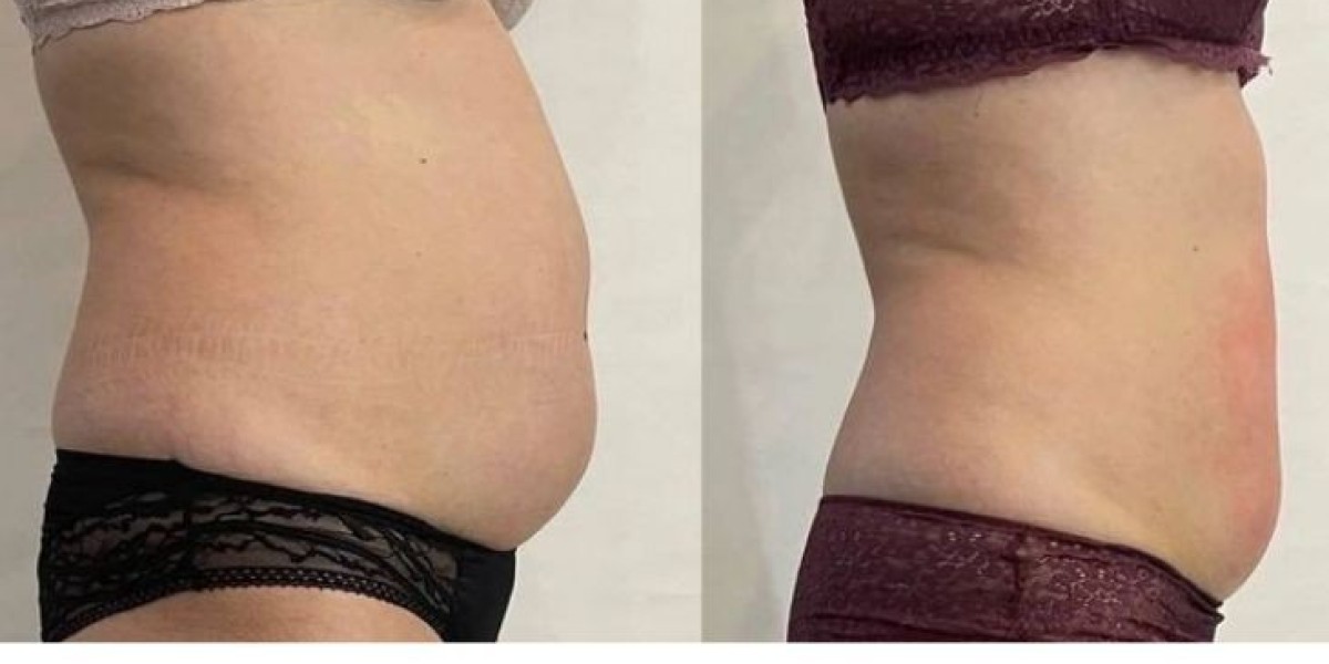 Reshape Your Body with Safe Liposuction in Islamabad