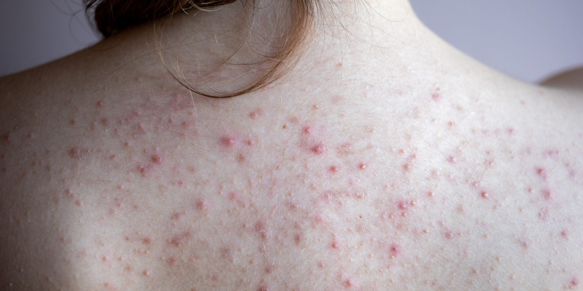 How Is Shingles Treated and What Results Can Patients Expect?