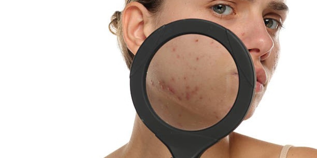 Laser Acne Treatment: Erase Scars and Prevent Future Ones