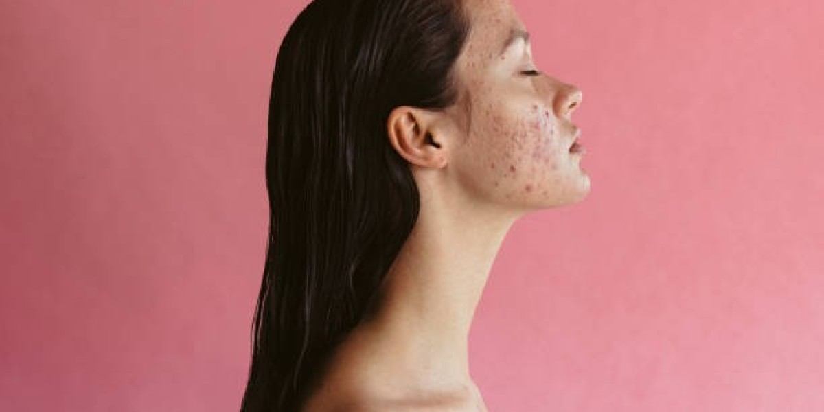 Restore Balance with Laser Acne Solutions