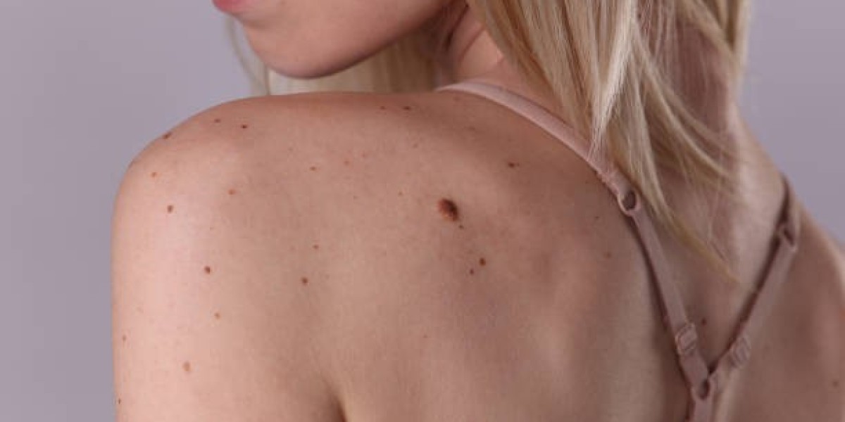 Skin Tag Removal Benefits for Long Term Skin Health