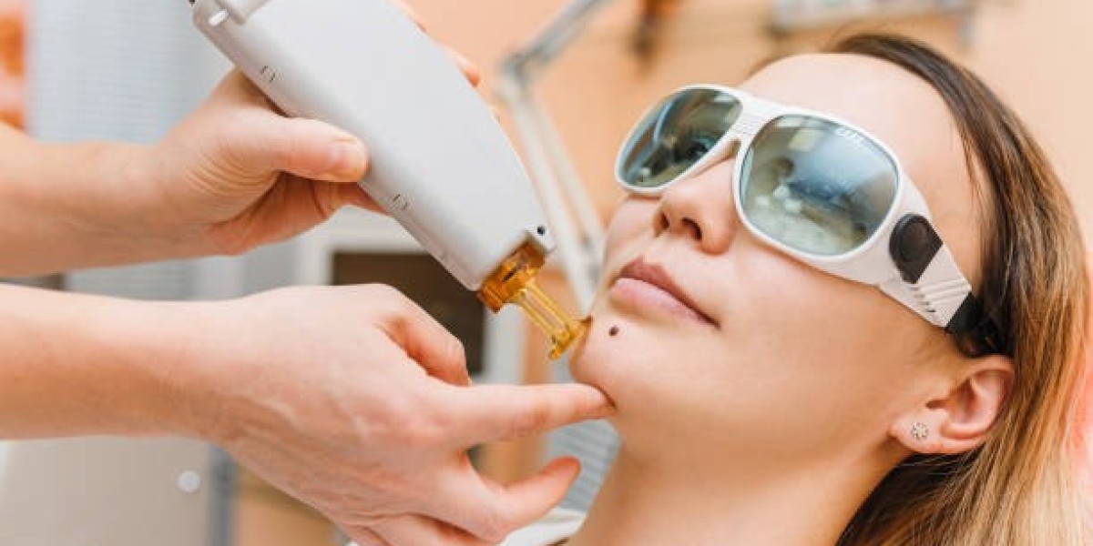 Cryotherapy for Mole Removal: Is It Right for Your Skin Type?