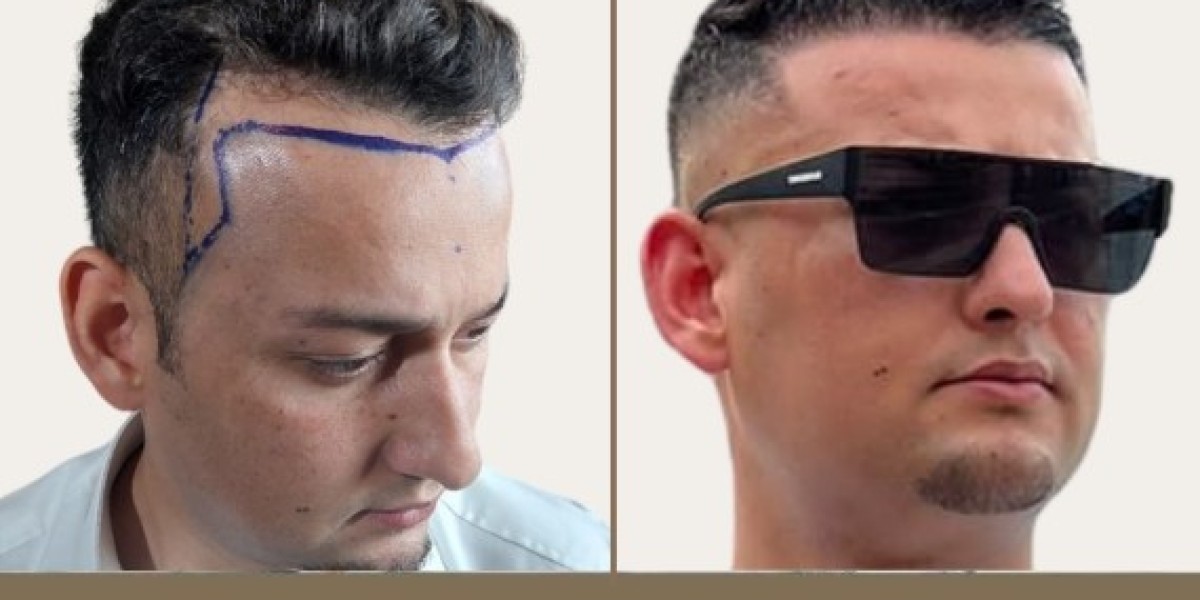 Choosing Excellence: The Definitive Guide to the Best Hair Transplant in Pakistan"