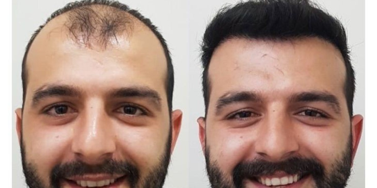 Hair Transplant in Islamabad: Myths vs Facts