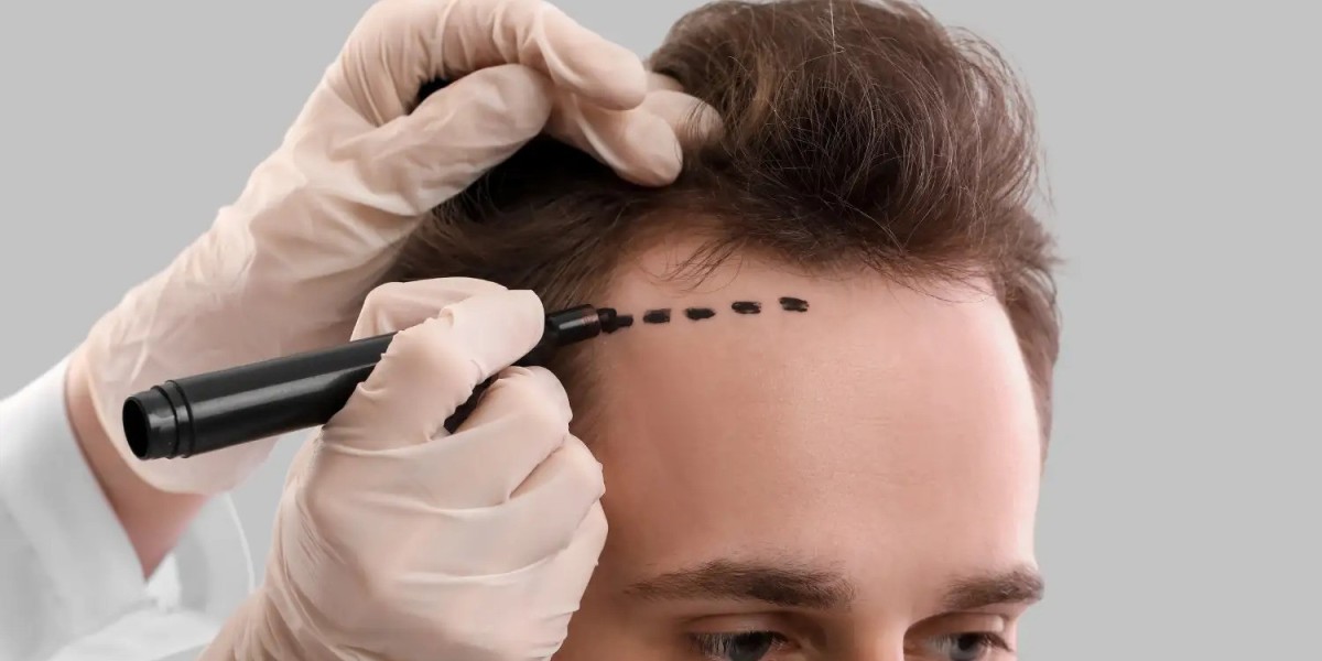 Trusted Hair Transplant Solutions Backed by Medical Expertise