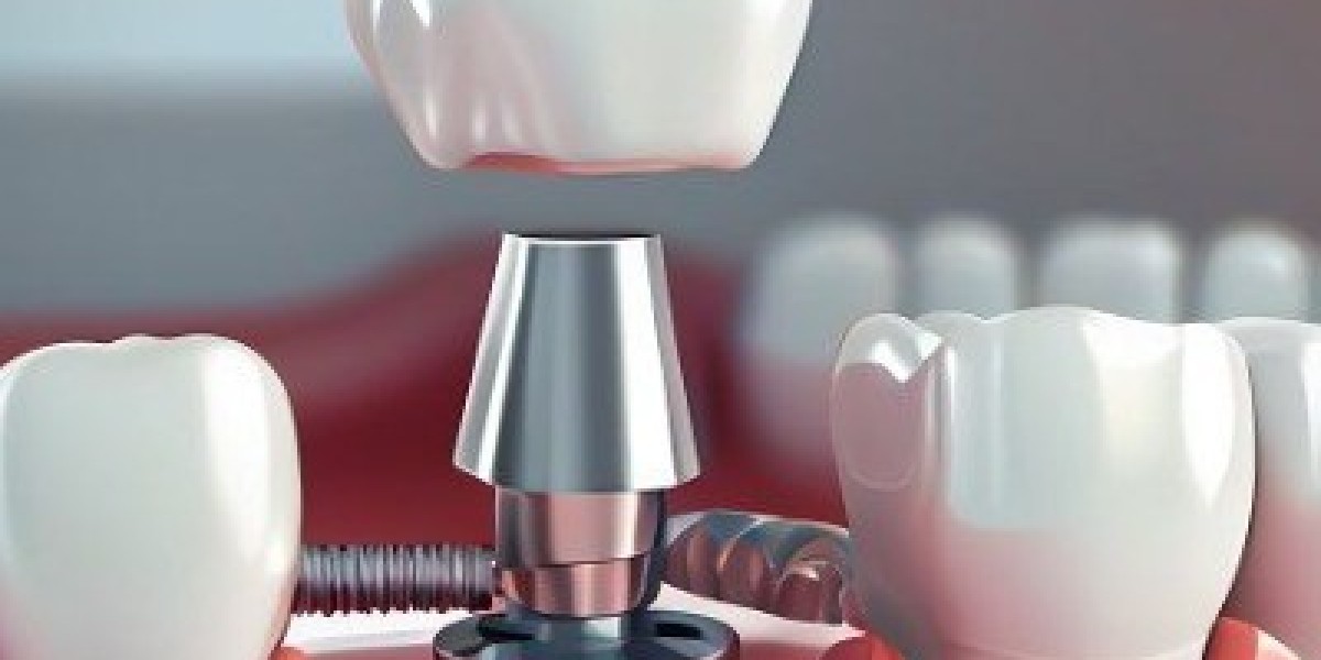 Dental Veneers in Islamabad: Cost and Financing Options for a Perfect Smile