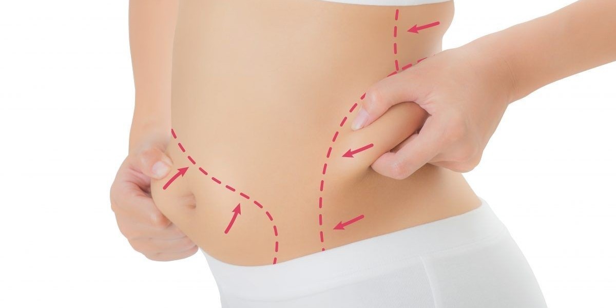 Liposuction for Body Refinement and Symmetry