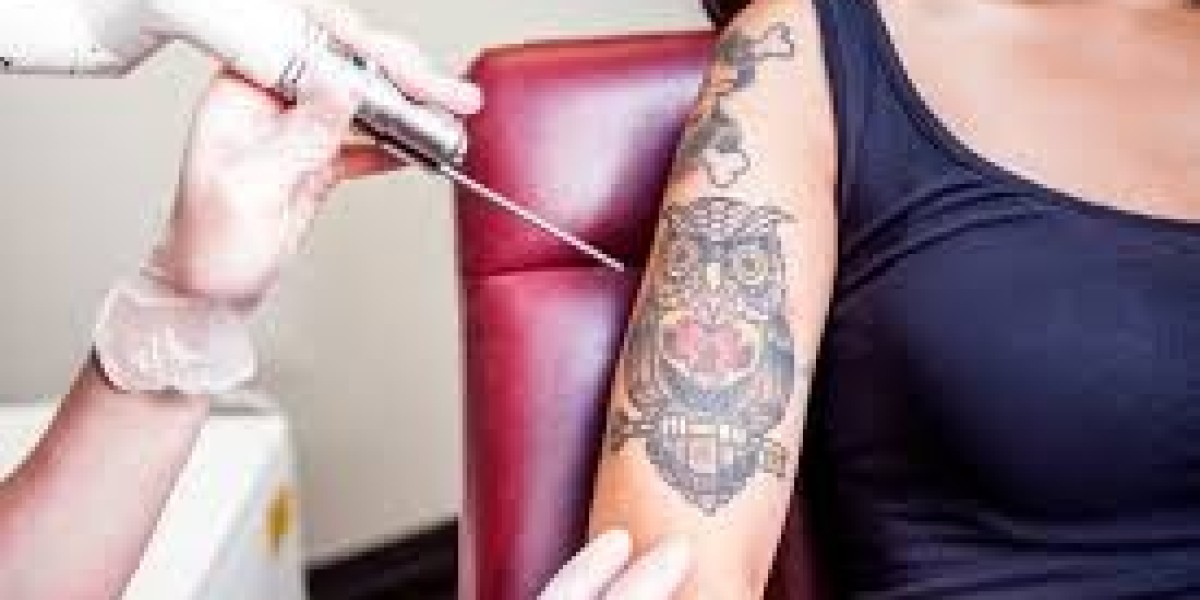 How Long Does It Take to Remove a Tattoo in Islamabad with Laser?