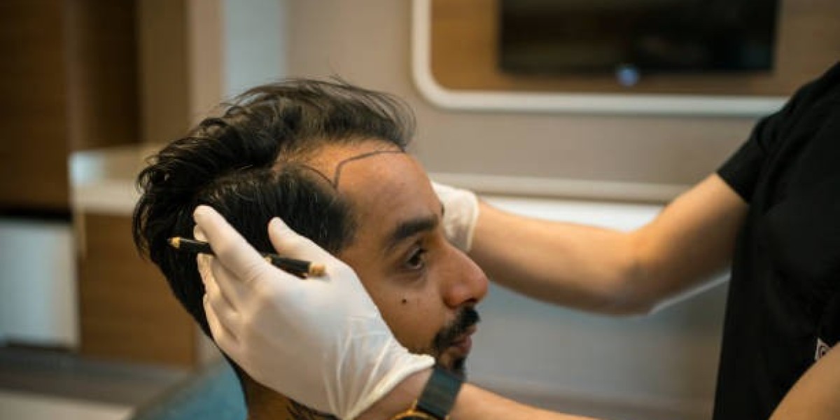 Scarless Hair Transplant in Dubai: No Shave Technique