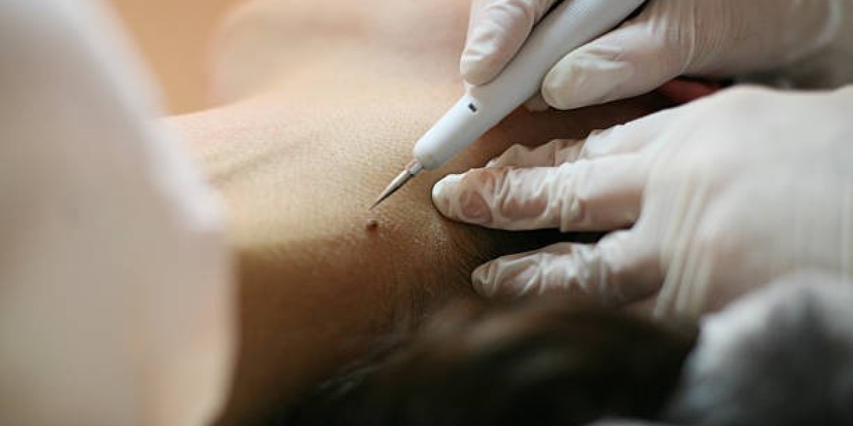 Mole Removal in Dubai: Dark Mole Pigmentation Fixes
